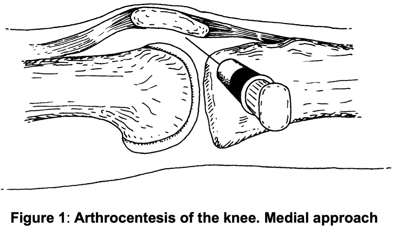 Knee-aspiration-1